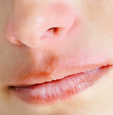 Foto einer Nahaufnahme von trockenen Lippen und geröteter Nase