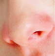 Foto einer Nahaufnahme von einer geröteten und trockenen Nase