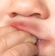 Foto einer Nahaufnahme eines Kleinkindes mit einem Schnullerekzem um die Lippen