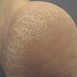 Foto Nahaufnahme Ferse mit extrem trockener, schuppiger Haut
